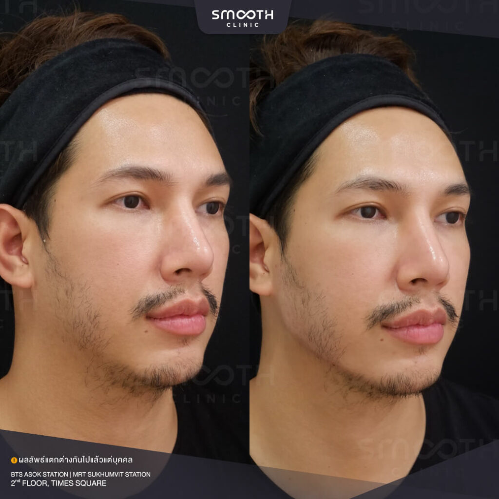 รีวิวฟิลเลอร์ smooth clinic