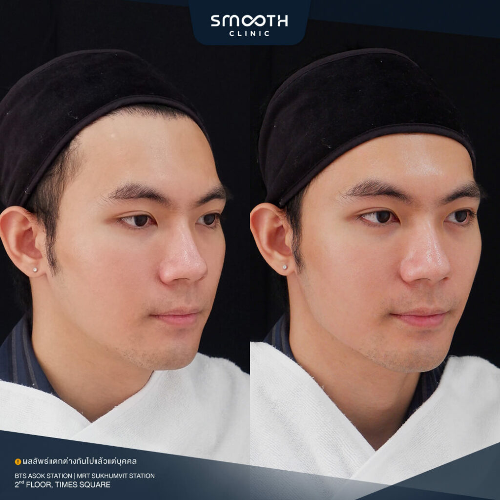 รีวิวฟิลเลอร์ smooth clinic
