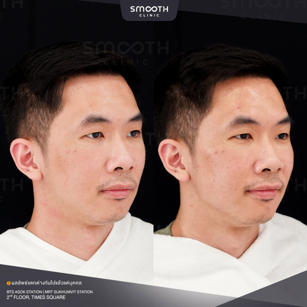 รีวิวฟิลเลอร์ smooth clinic