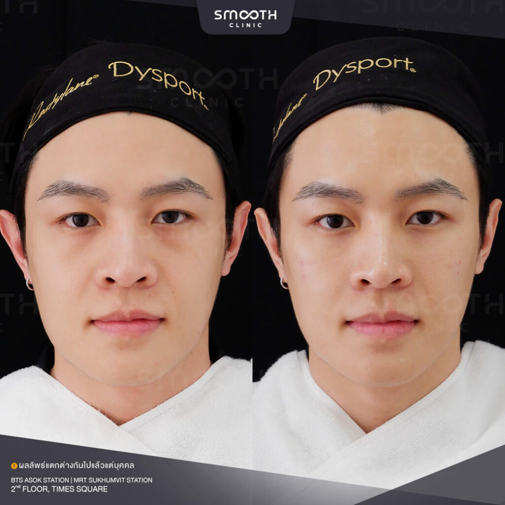 รีวิวฟิลเลอร์ smooth clinic