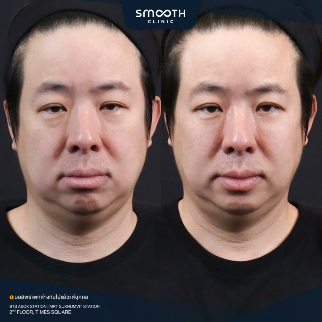 รีวิวฟิลเลอร์ smooth clinic