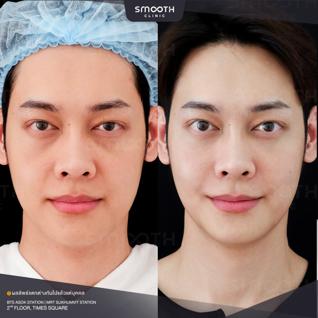 รีวิวฟิลเลอร์ smooth clinic