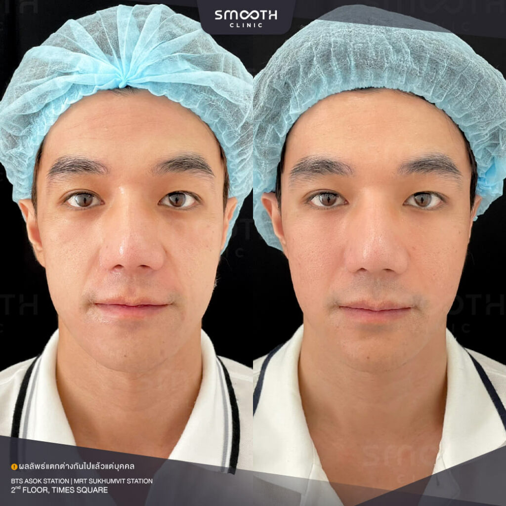 รีวิวฟิลเลอร์ smooth clinic