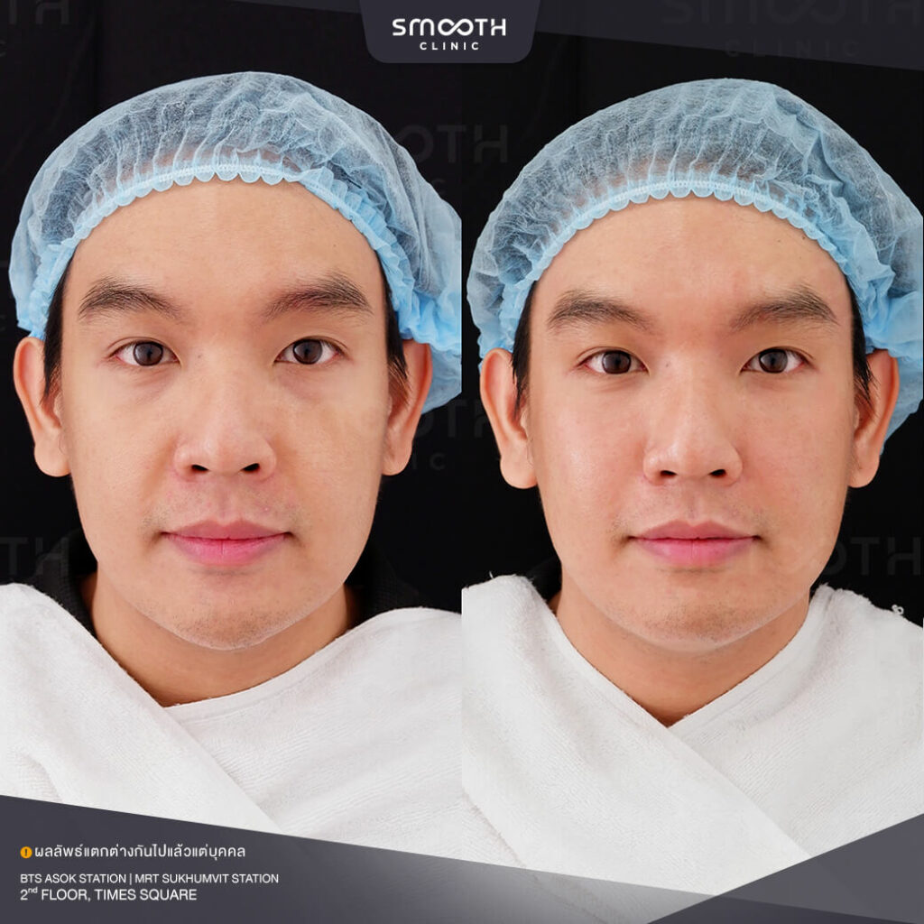 รีวิวฟิลเลอร์ smooth clinic