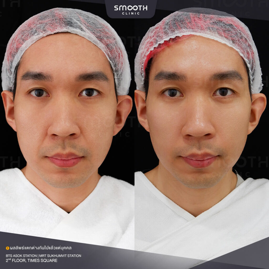 รีวิวฟิลเลอร์ smooth clinic