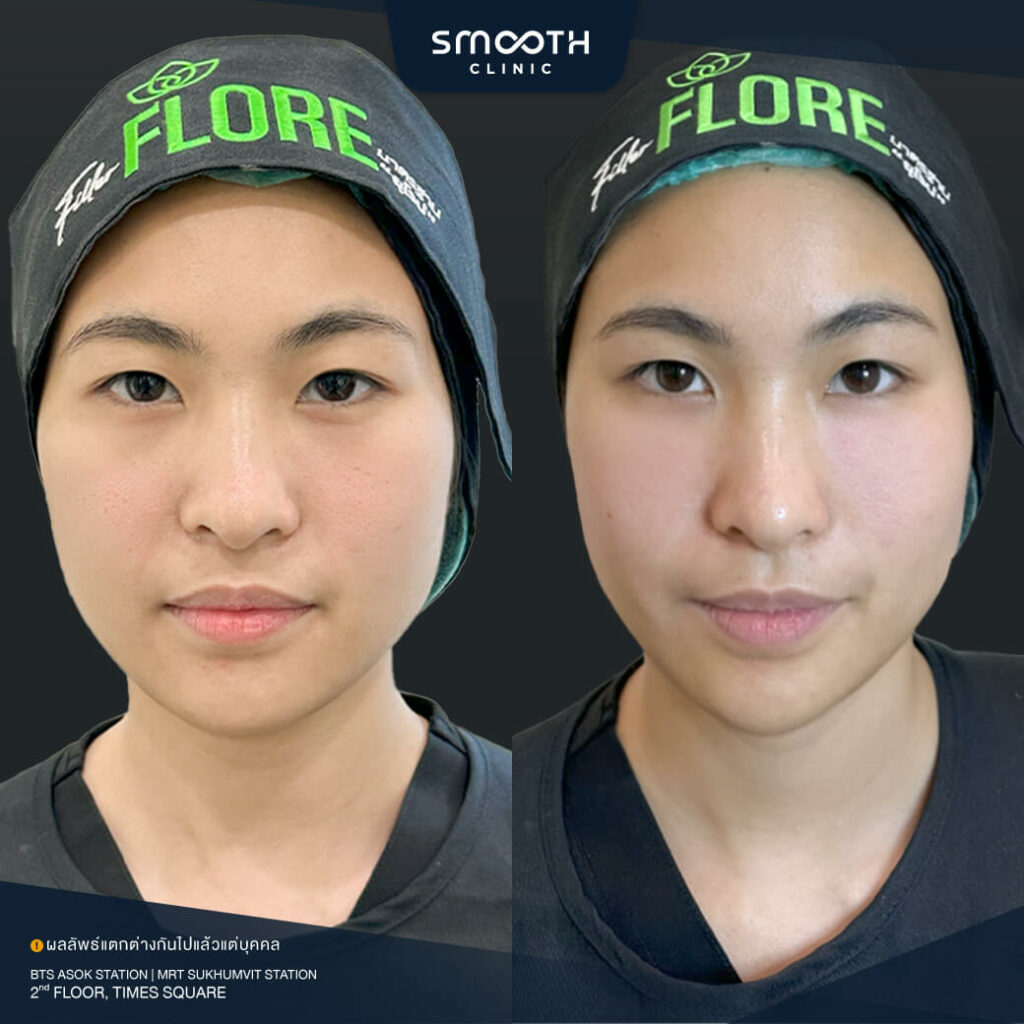 รีวิวฟิลเลอร์ smooth clinic