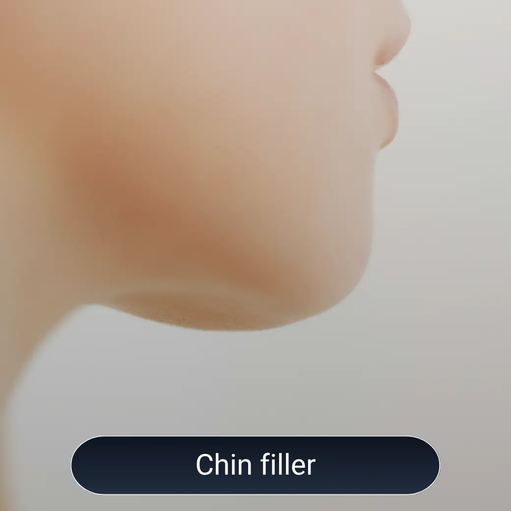 chin filler