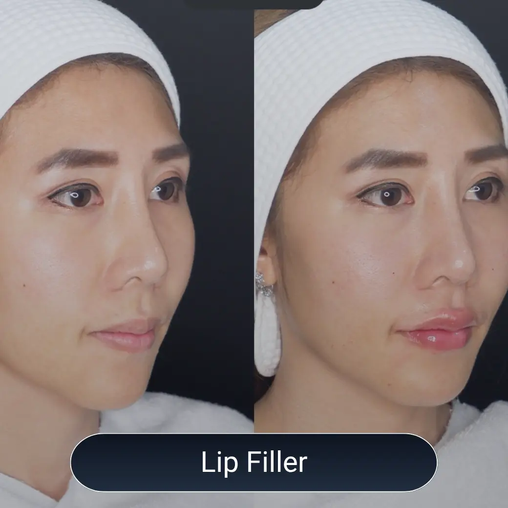 Lip Filler Trends Must-Try Korean x Western Styles 2025