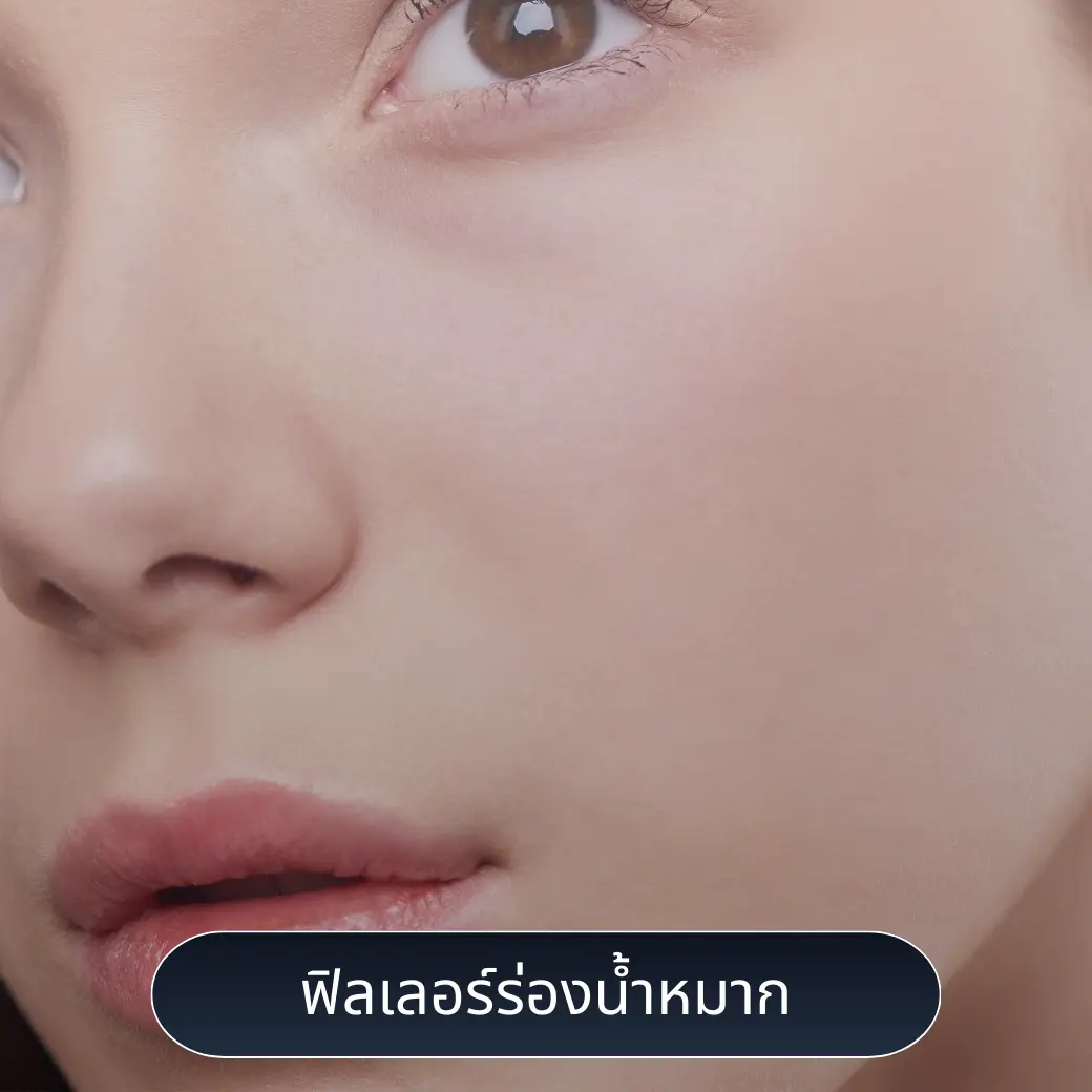 ฟิลเลอร์ร่องน้ำหมาก แก้ปัญหาร่องลึก หมดปัญหาหน้าแก่