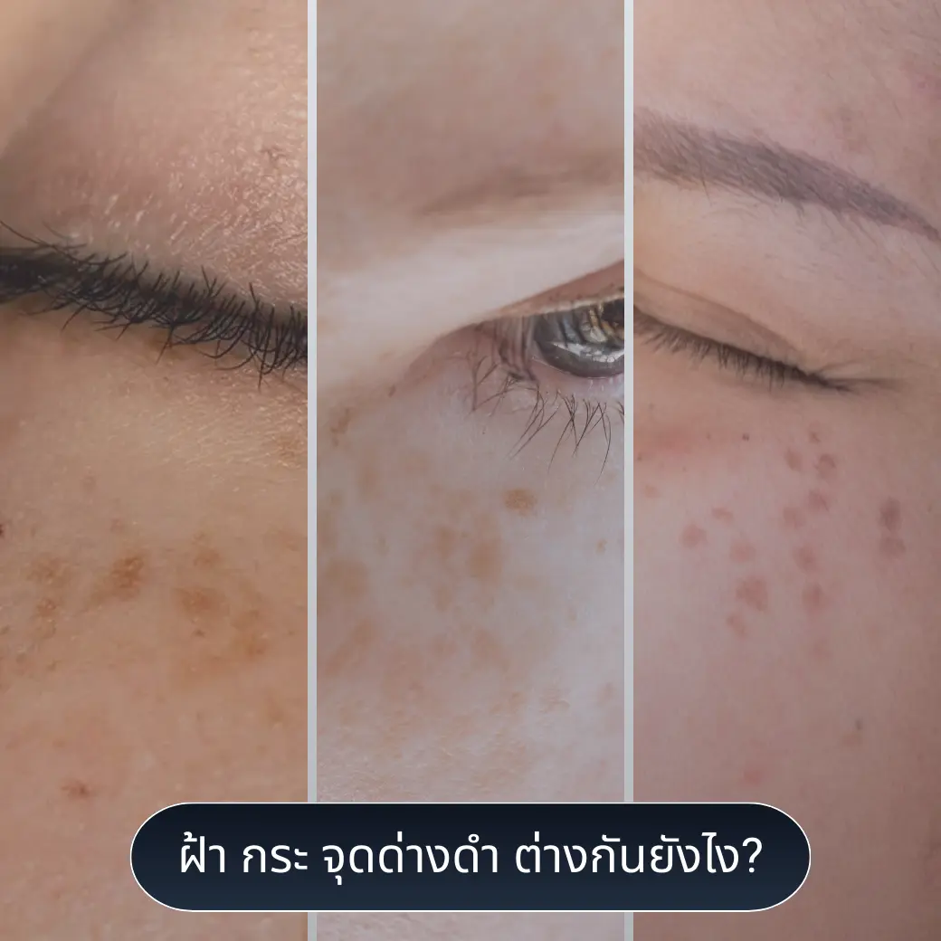 รักษาฝ้า กระ จุดด่างดำ