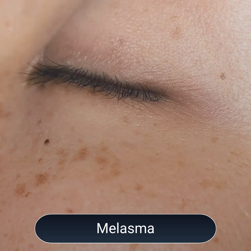 melasma