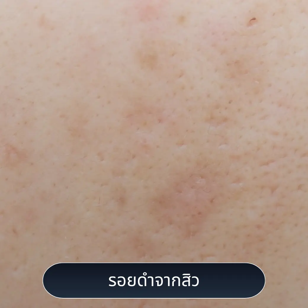 รอยดำจากสิว