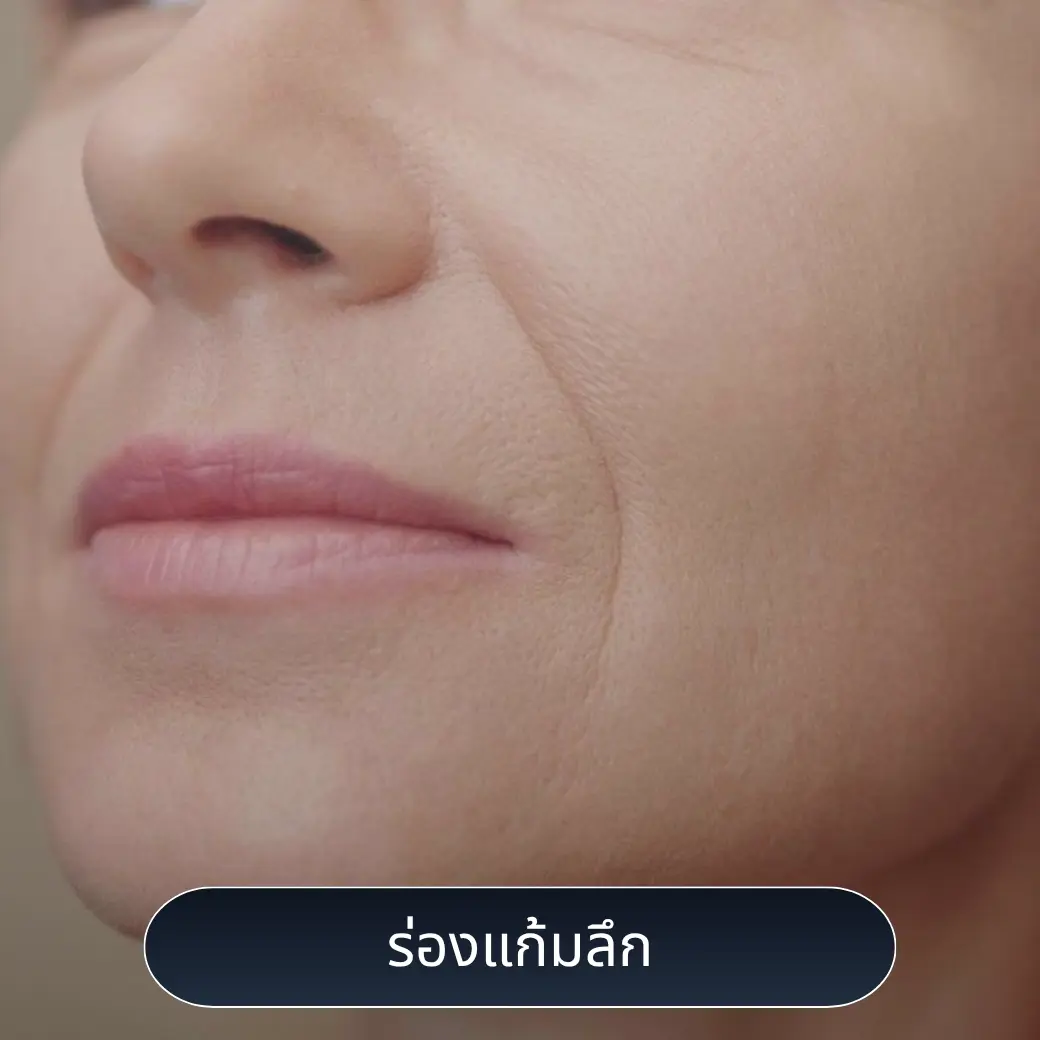 ร่องแก้มลึก แก้ยังไง