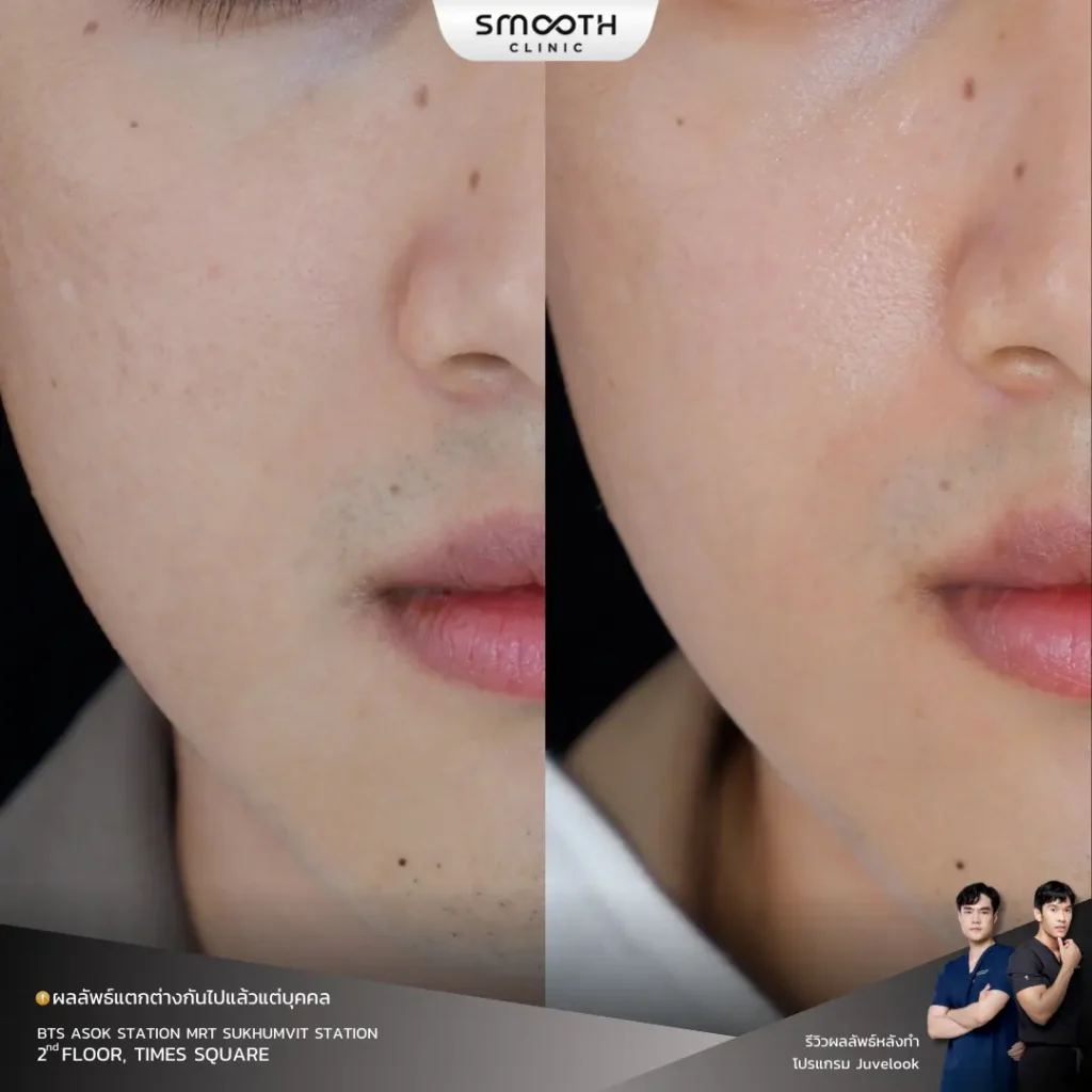 รีวิว bio juvelook หลุมสิว 1