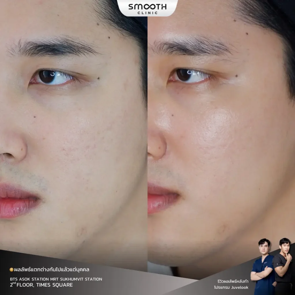 รีวิว bio juvelook หลุมสิว 2