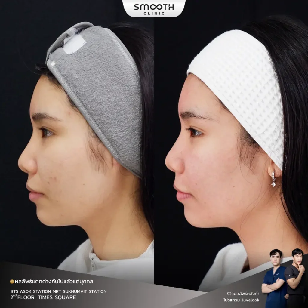 รีวิว bio juvelook หลุมสิว 3