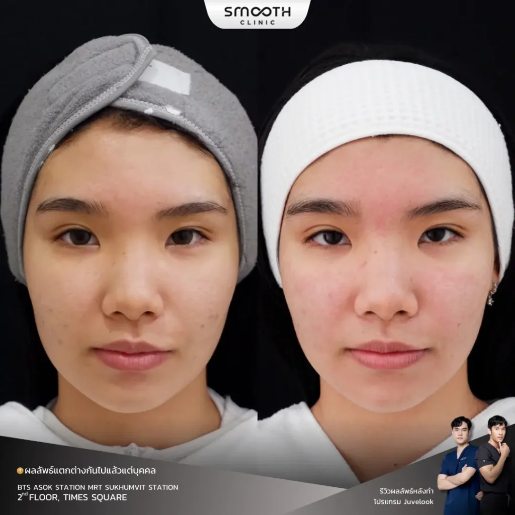 รีวิว bio juvelook หลุมสิว 4