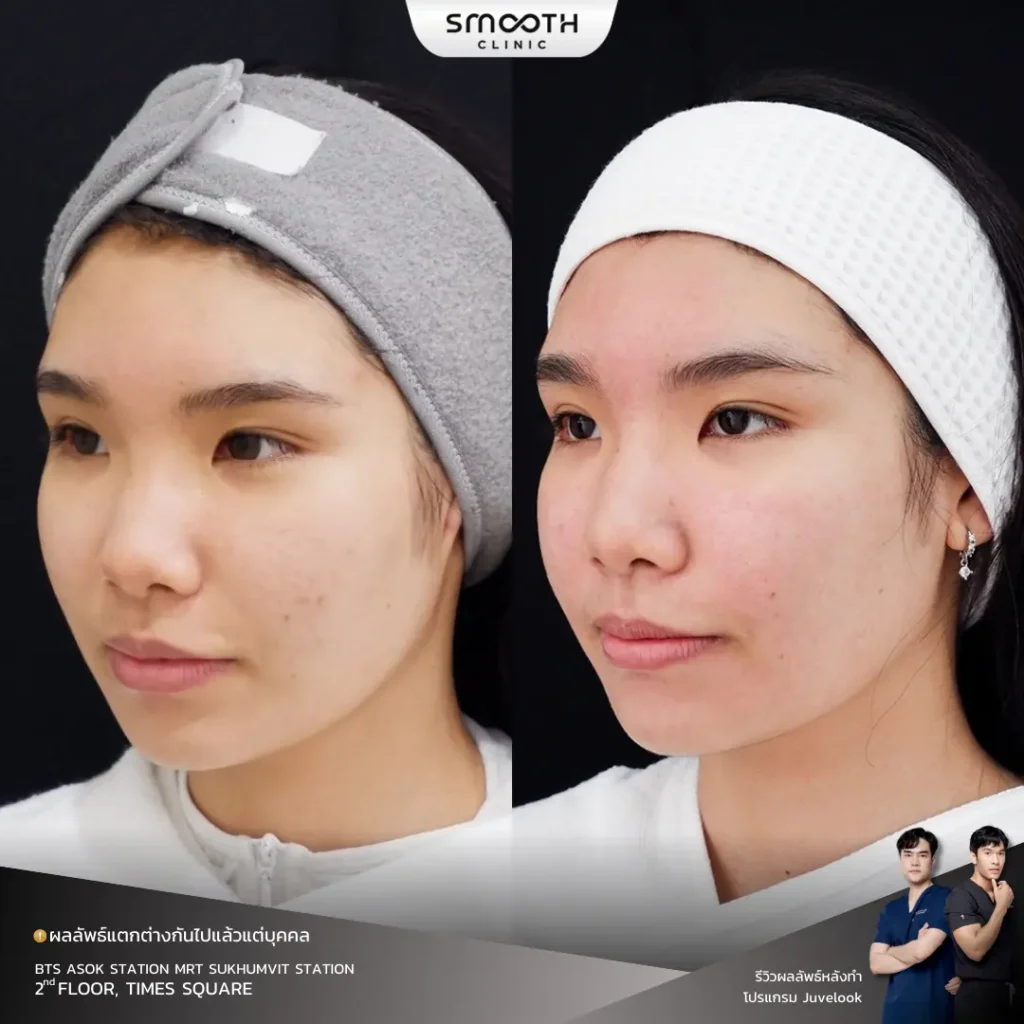 รีวิว bio juvelook หลุมสิว 6