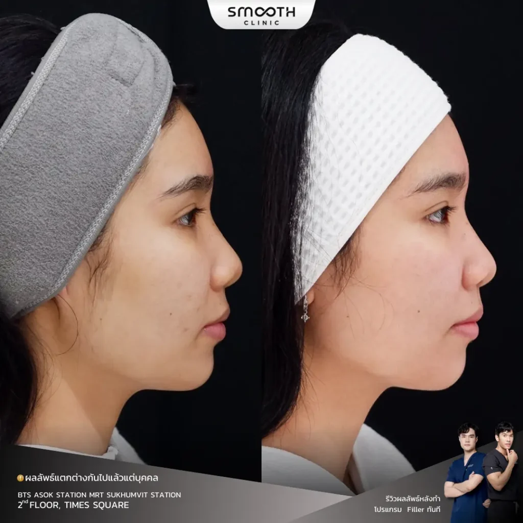 รีวิว bio juvelook หลุมสิว 7