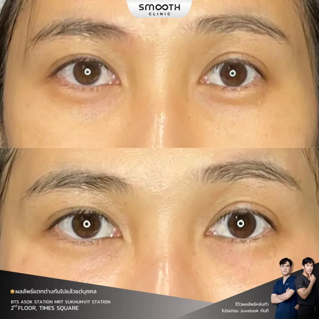 รีวิว bio juvelook ใตต้า 6