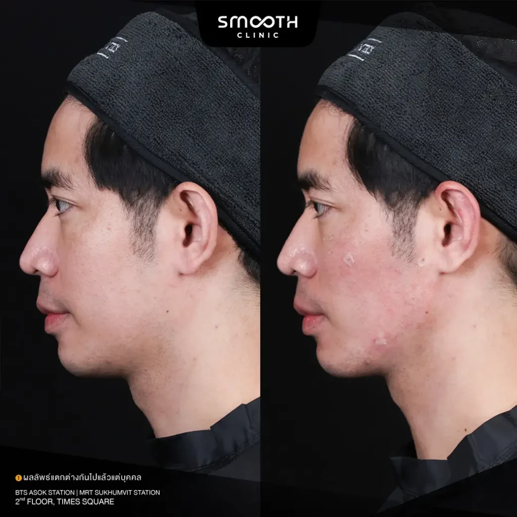 รีวิว bio radiesse plus 1