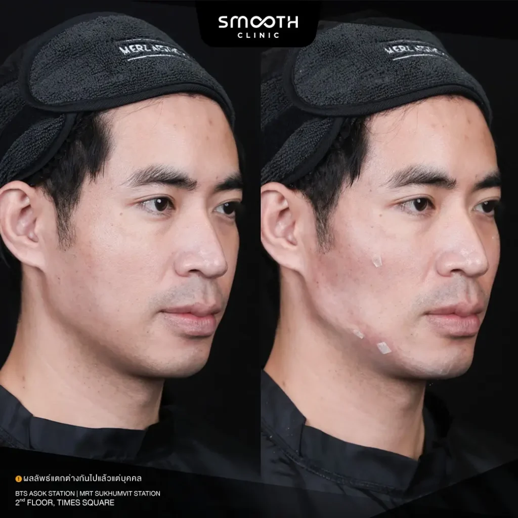 รีวิว bio radiesse plus 2