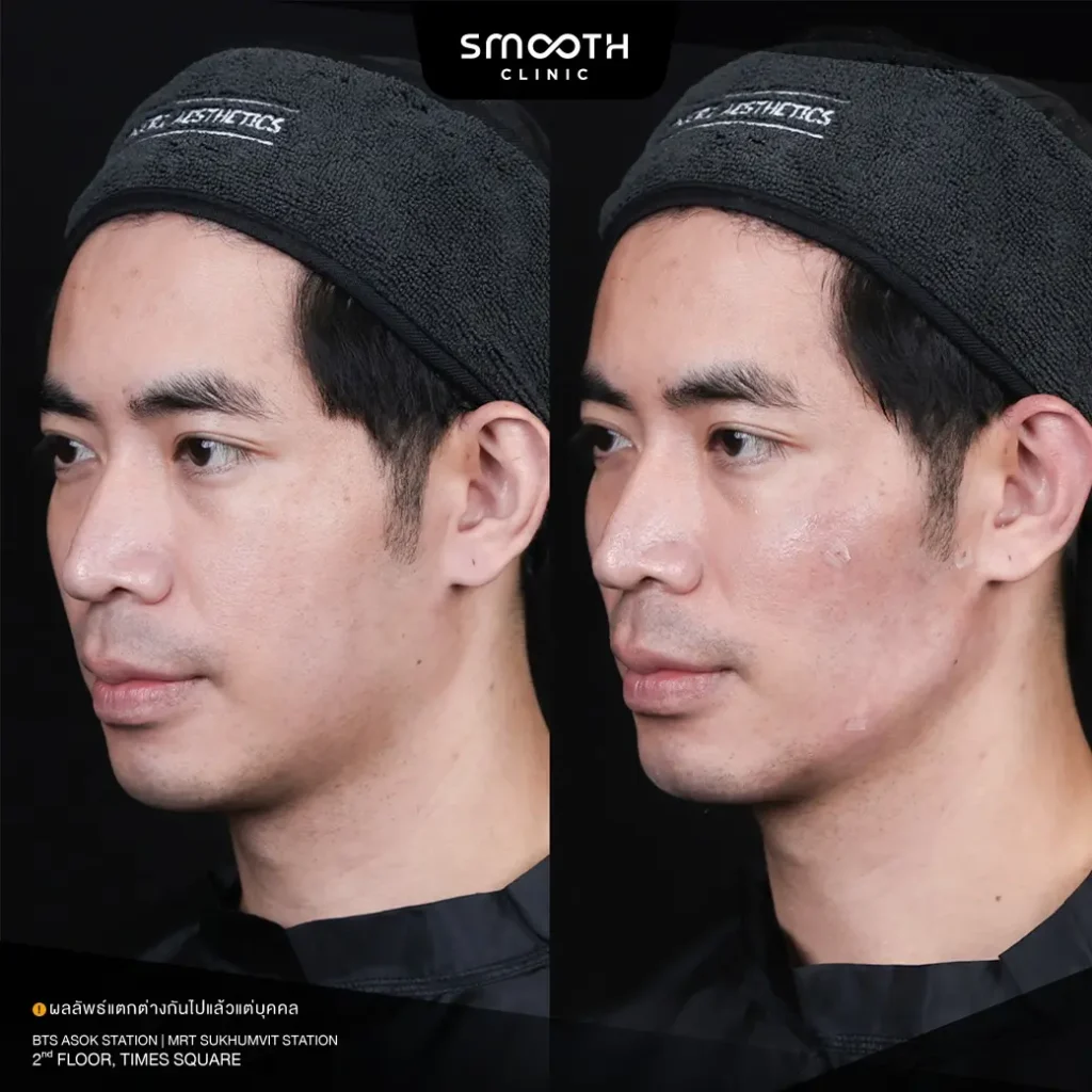 รีวิว bio radiesse plus 3