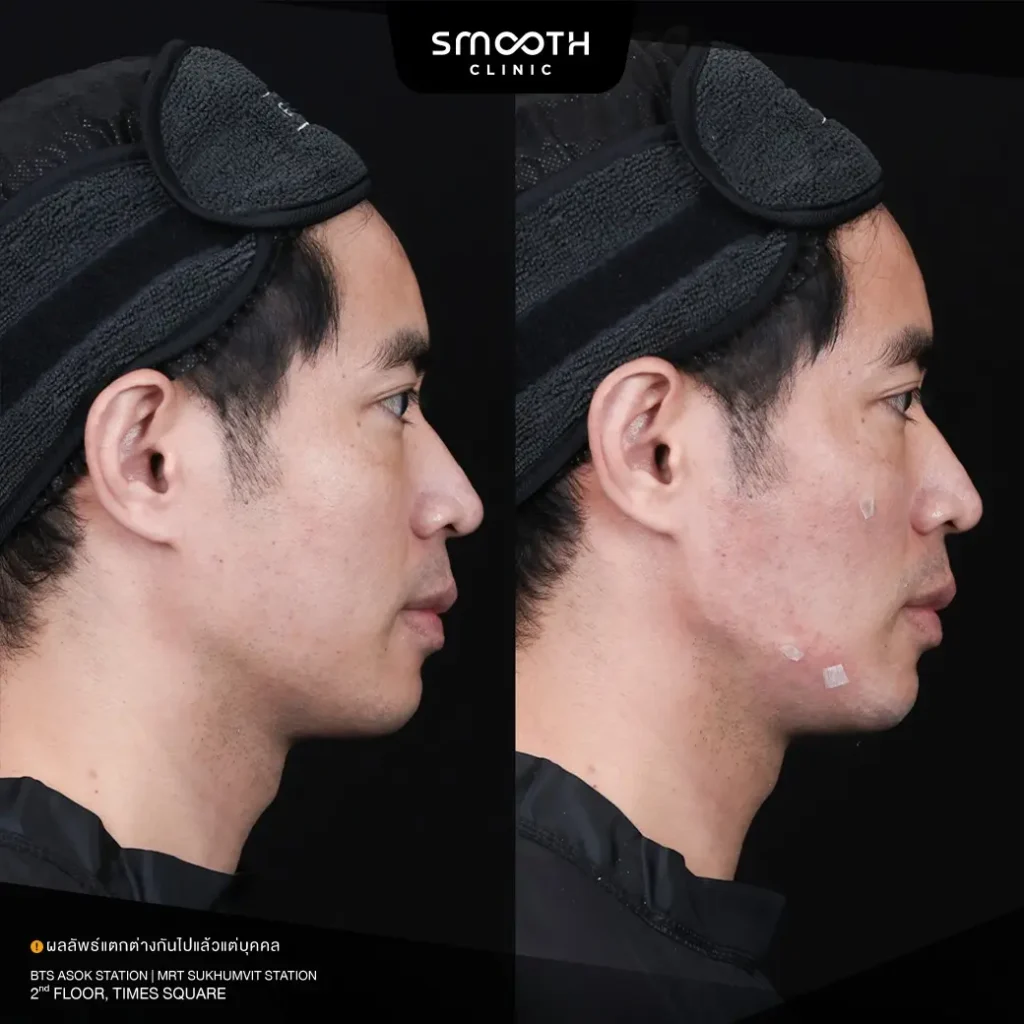 รีวิว bio radiesse plus 4