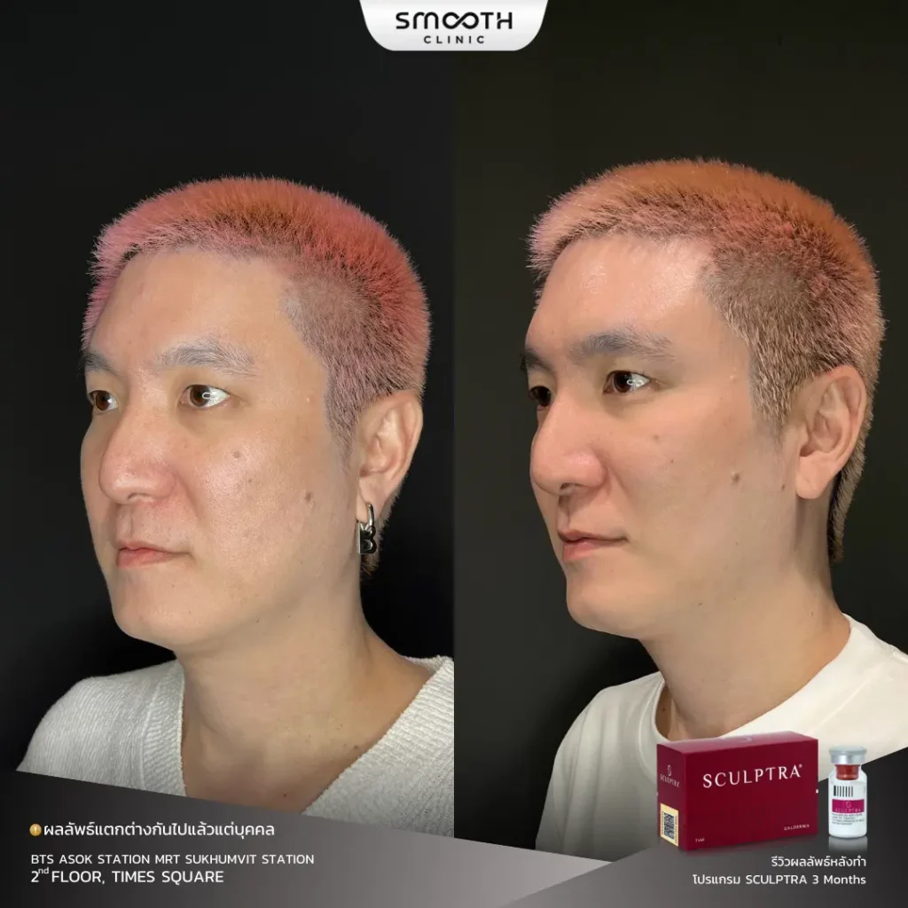 รีวิว bio sculptra 1