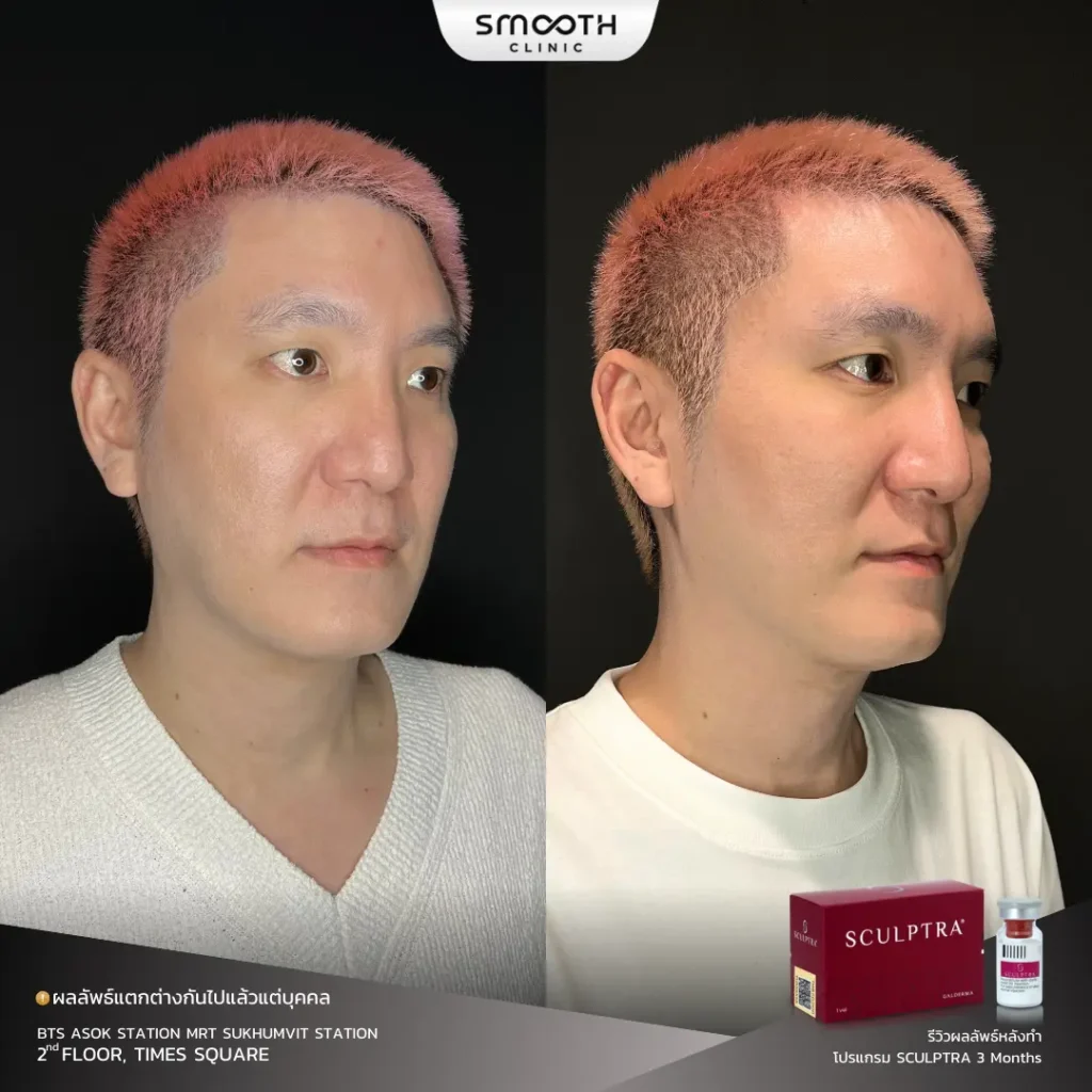 รีวิว bio sculptra 2