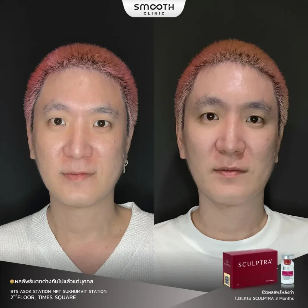 รีวิว bio sculptra 5