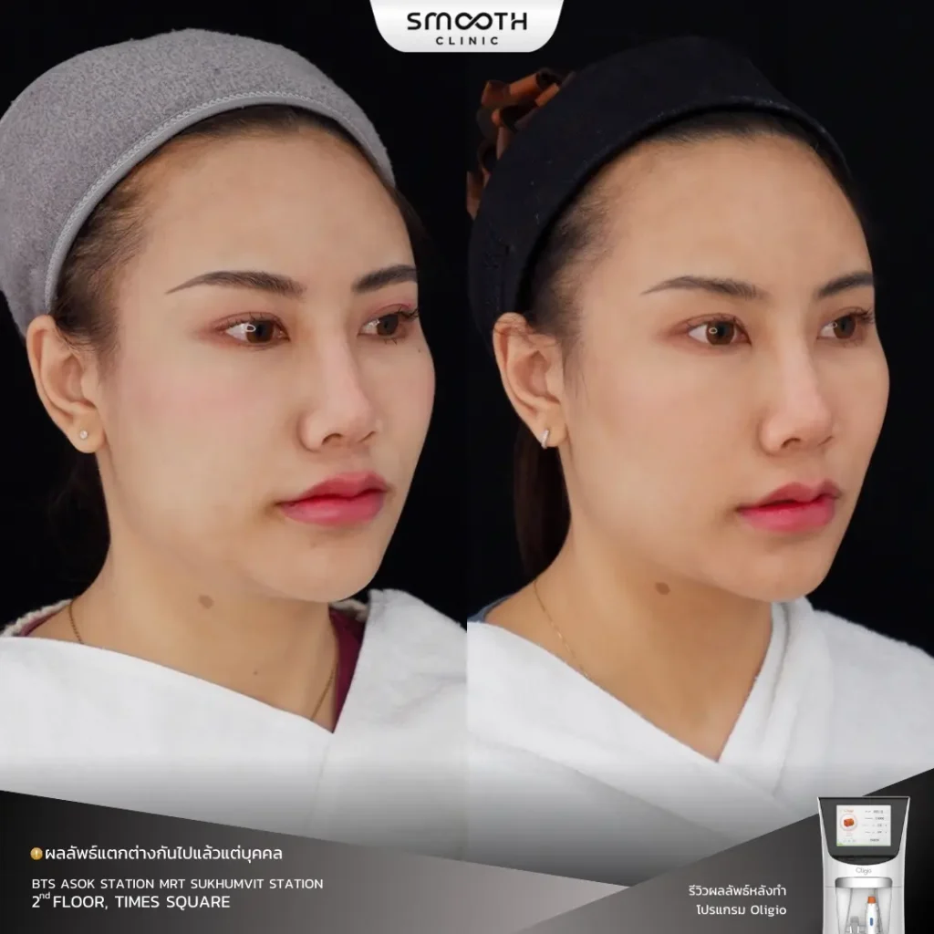 รีวิว oligio 3