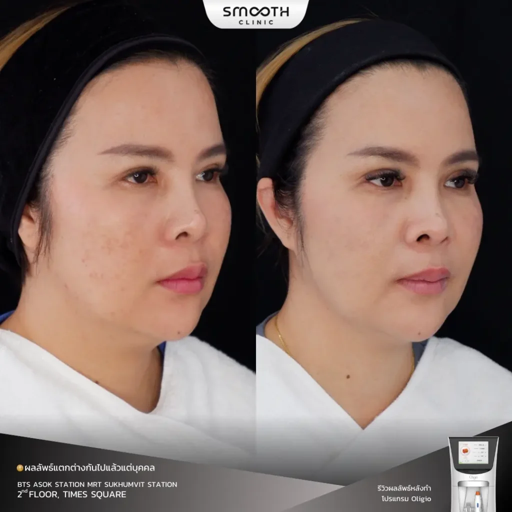 รีวิว oligio 4