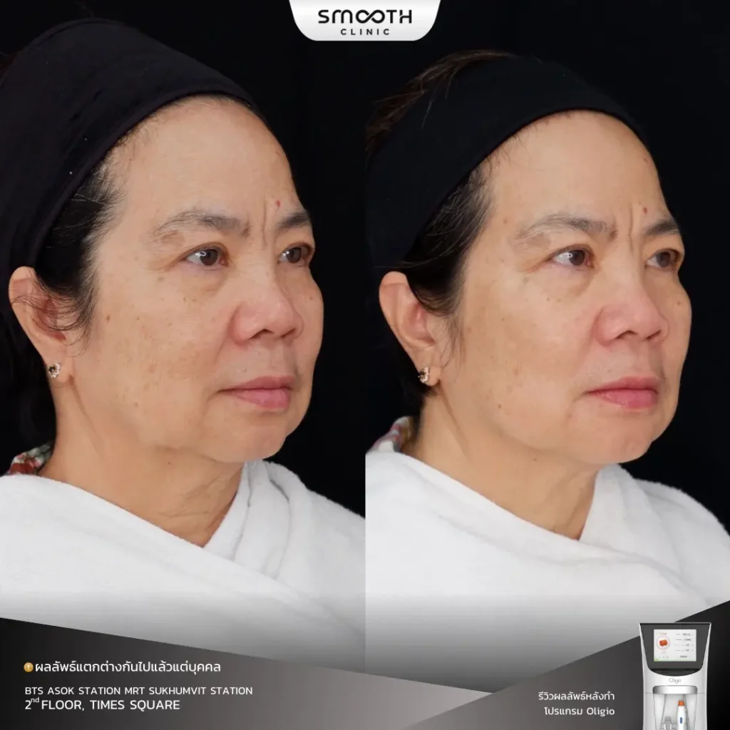 รีวิว oligio 5