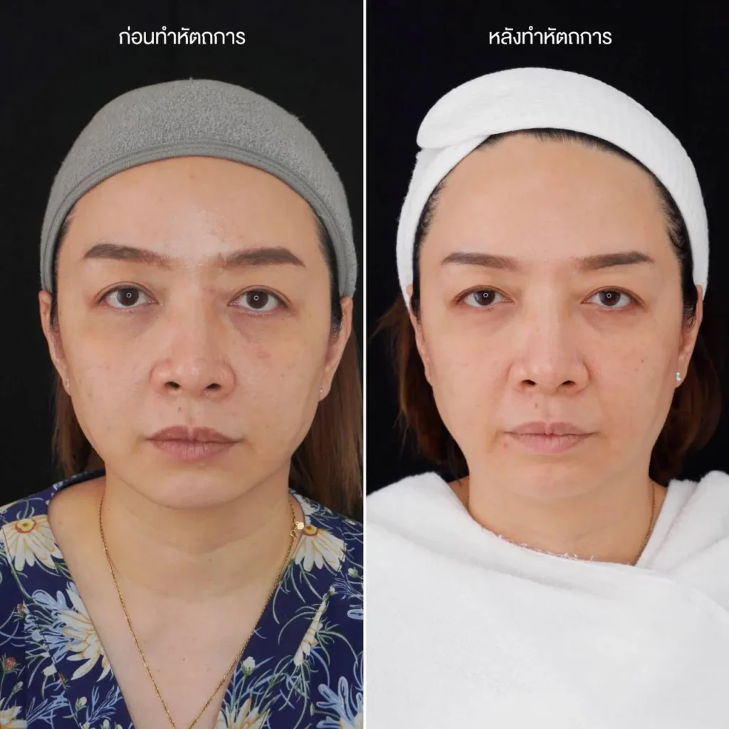 รีวิว sylfirm x 1