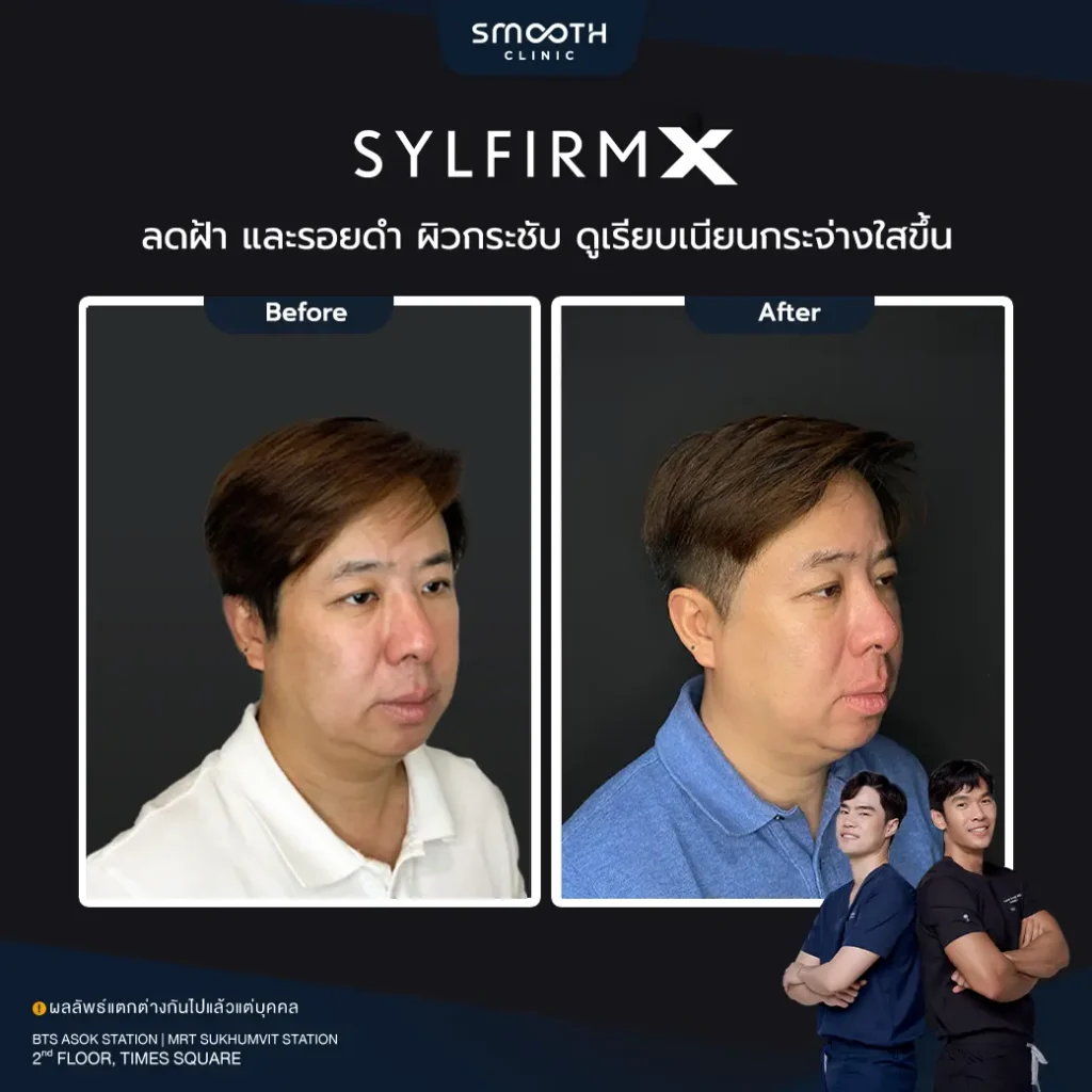 รีวิว sylfirm x 2