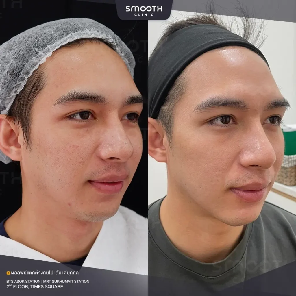 รีวิว sylfirm x juvelook 1