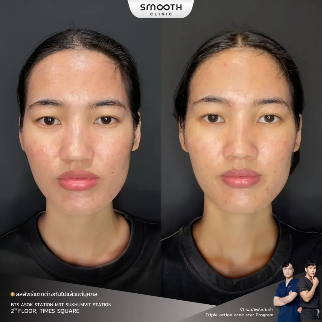 รีวิว sylfirm x หลุมสิว 1