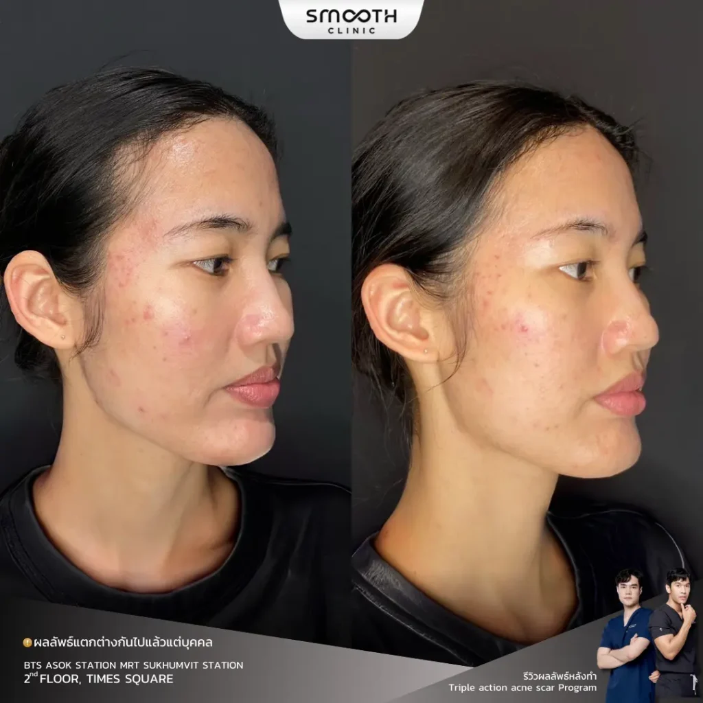 รีวิว sylfirm x หลุมสิว 2