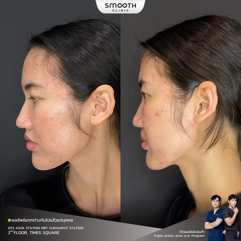 รีวิว sylfirm x หลุมสิว 3