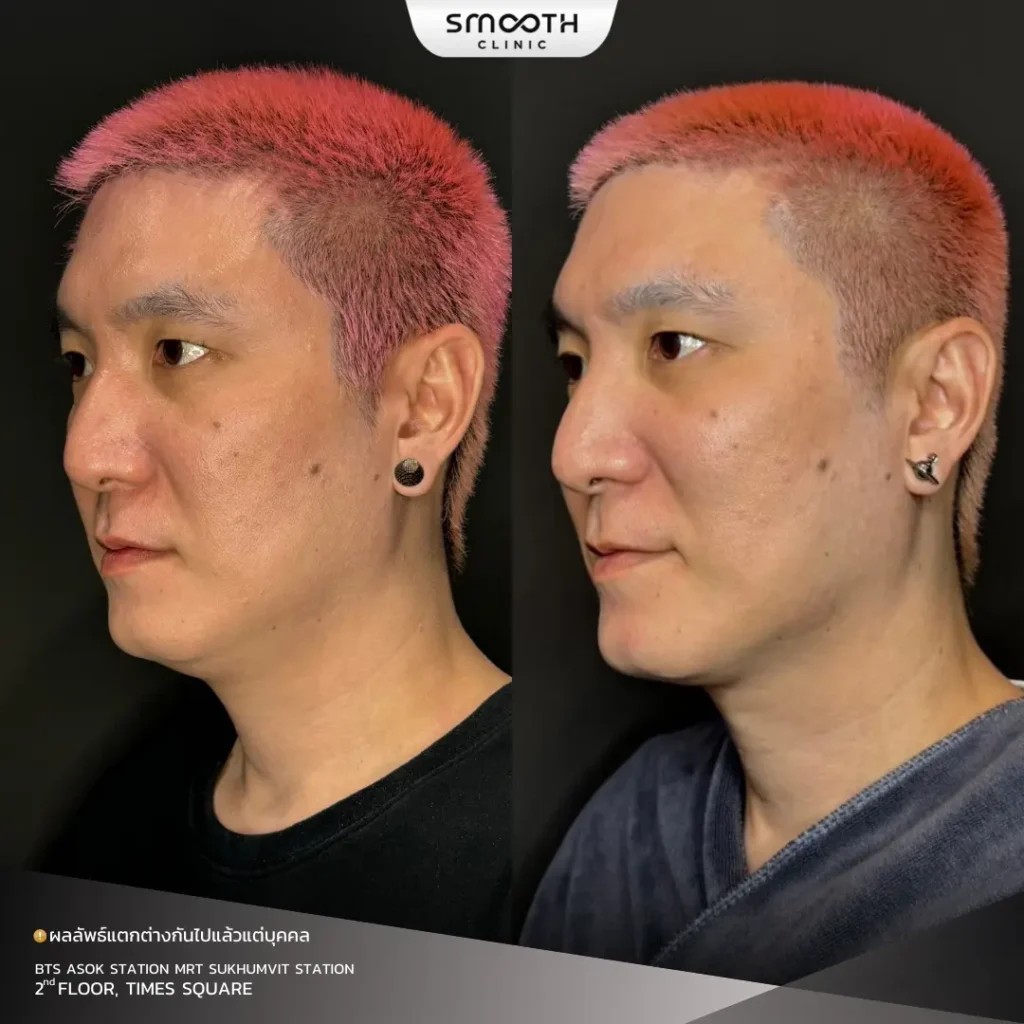 รีวิว ultheray prime 2