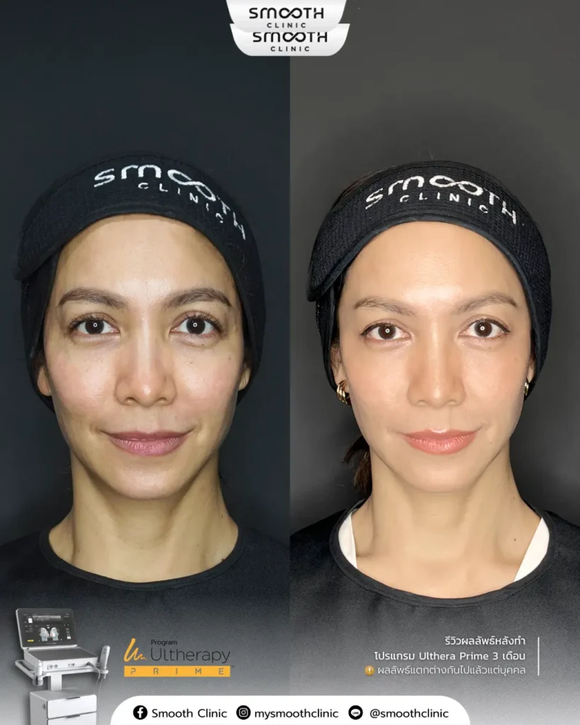 รีวิว ultheray prime 4