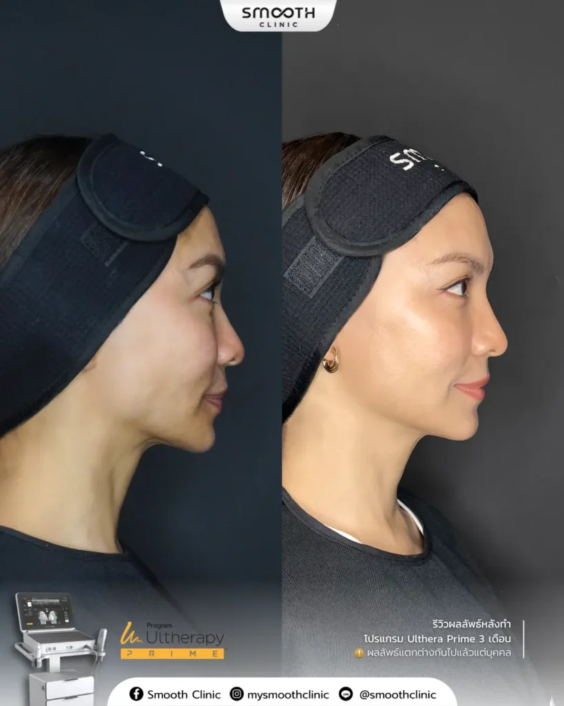 รีวิว ultheray prime 5