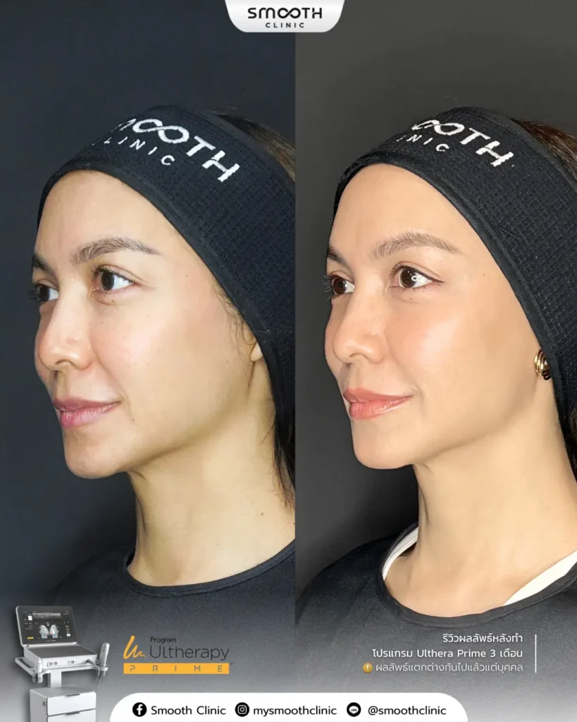 รีวิว ultheray prime 6