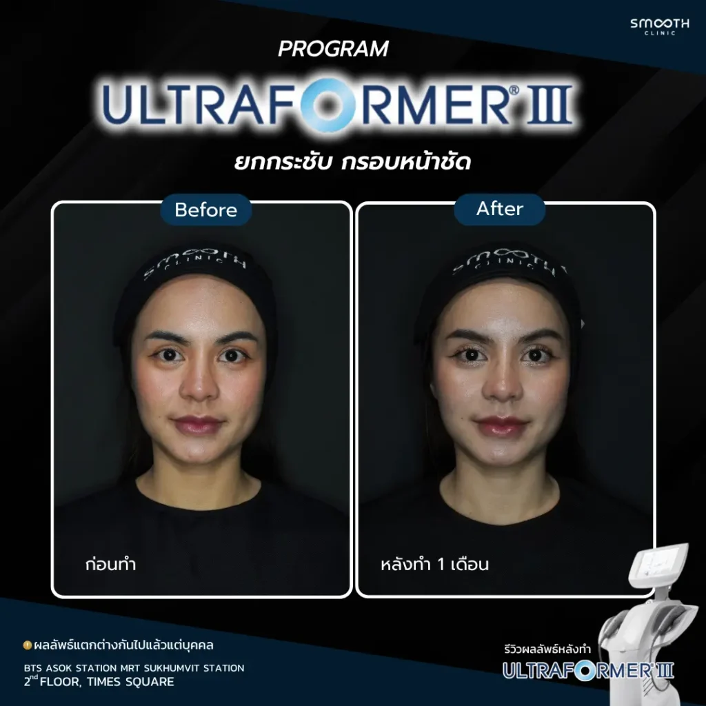รีวิว ultraformer iii 1