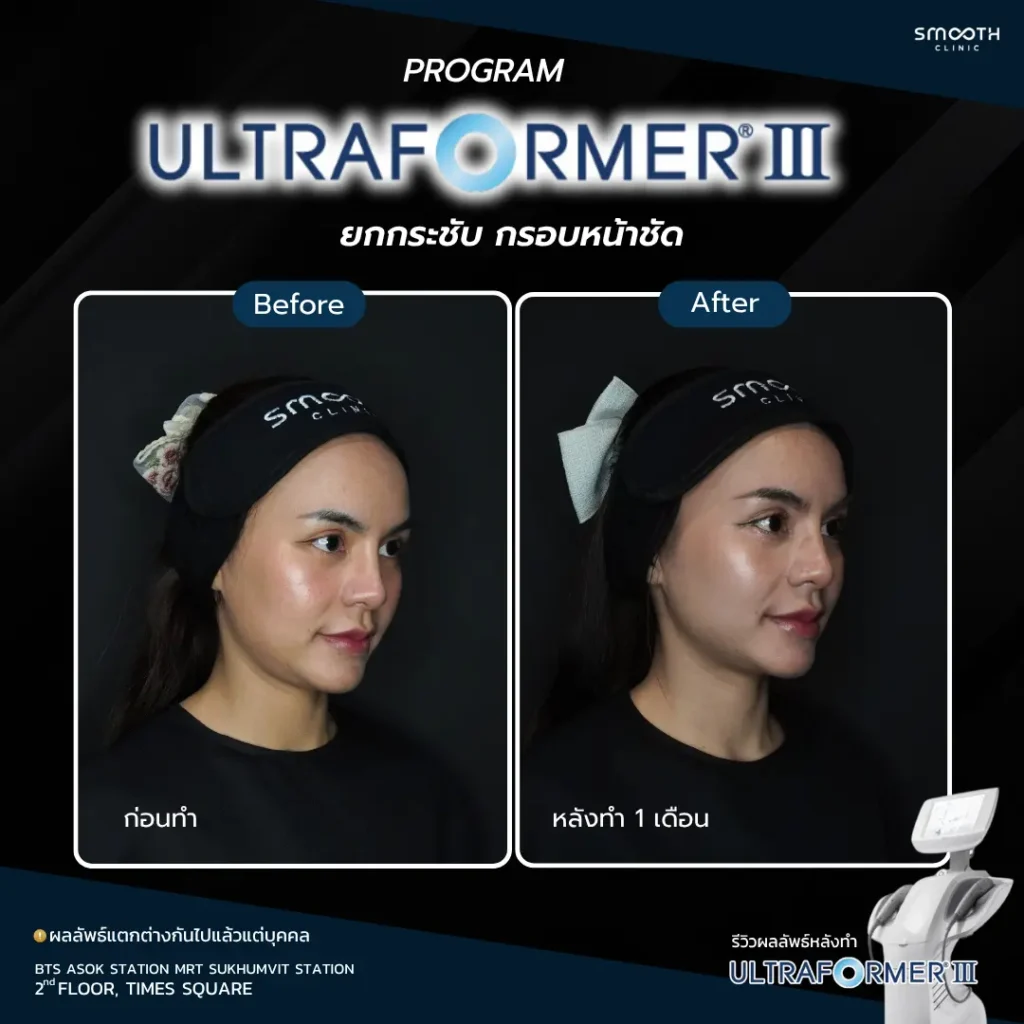 รีวิว ultraformer iii 2