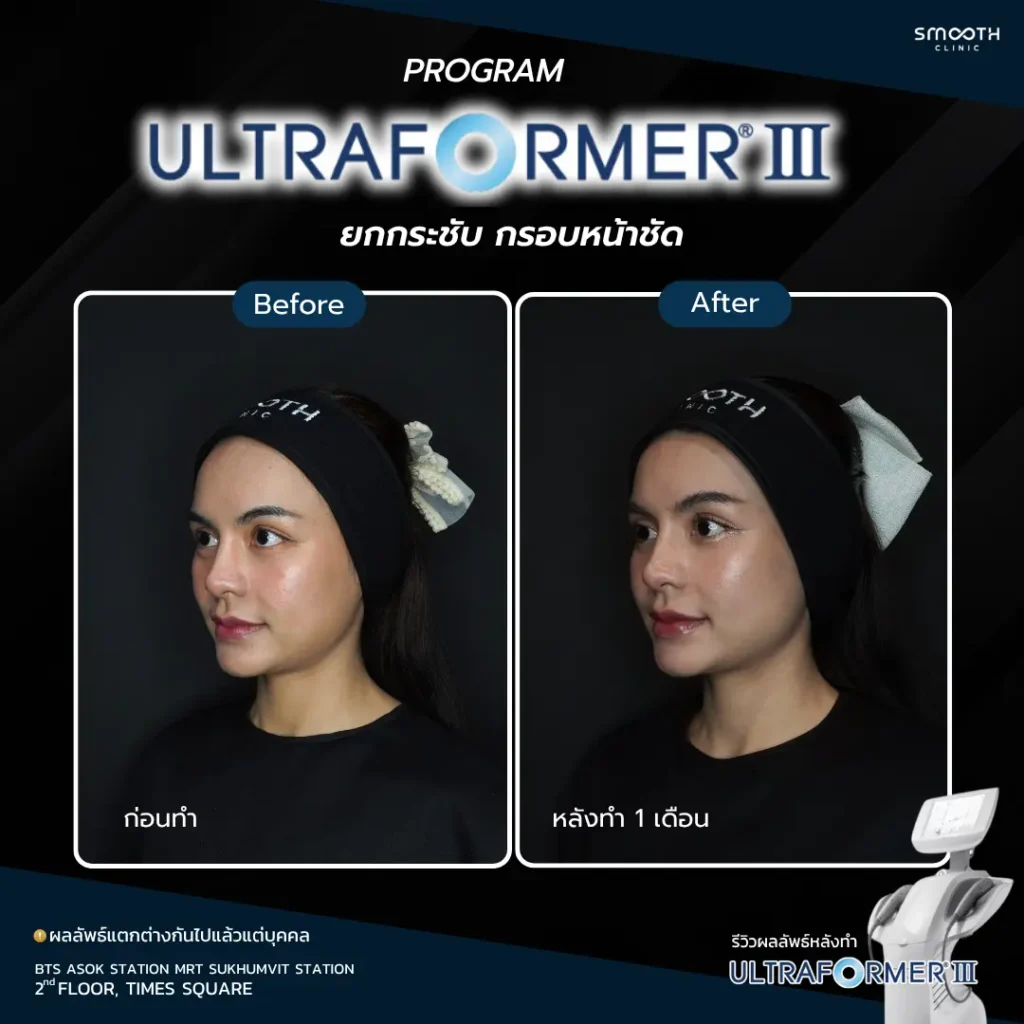 รีวิว ultraformer iii 3