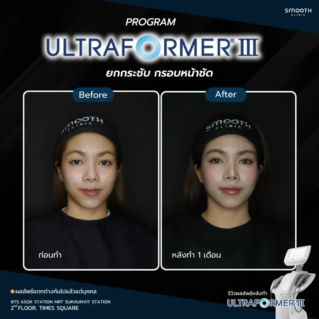 รีวิว ultraformer iii 4