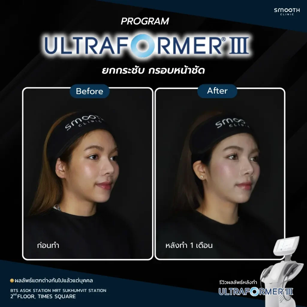 รีวิว ultraformer iii 5