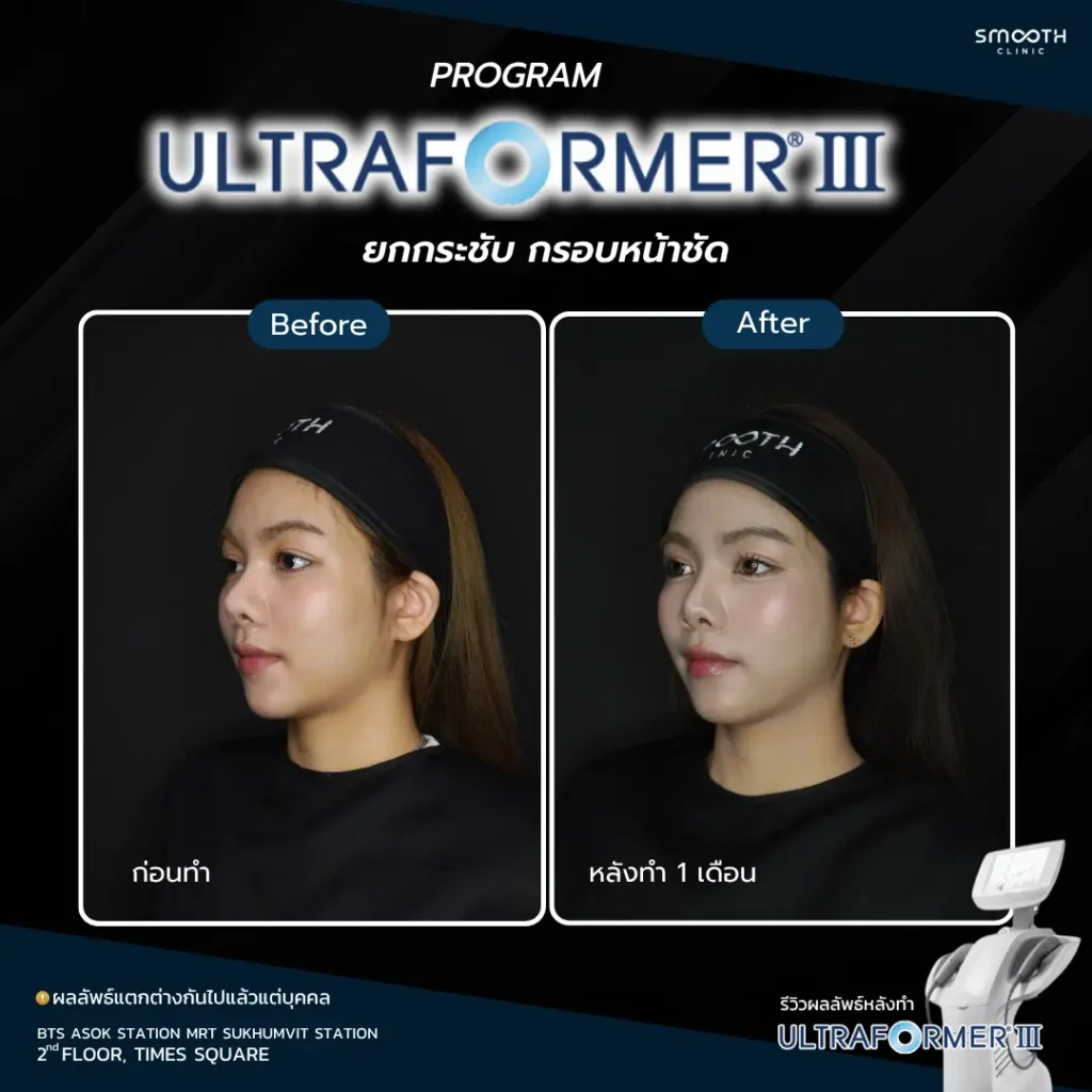 รีวิว ultraformer iii 6